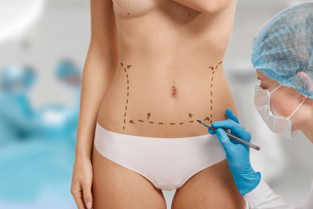 lipoescultura